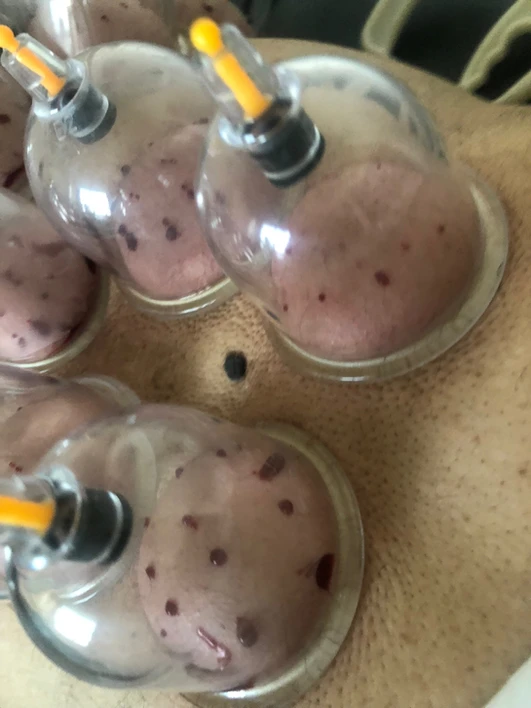 Hijama at the lower back