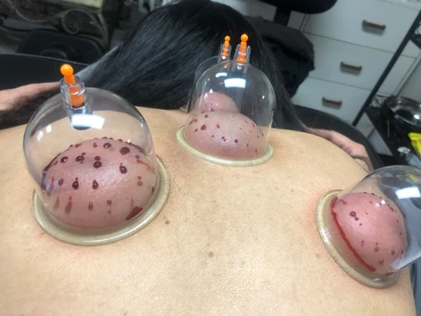 Systemic Hijama Points