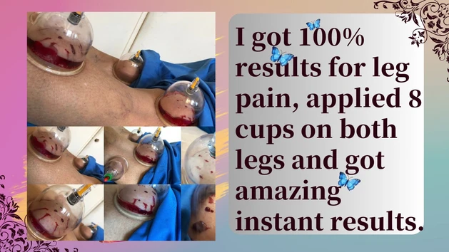 Leg Pain And Hijama