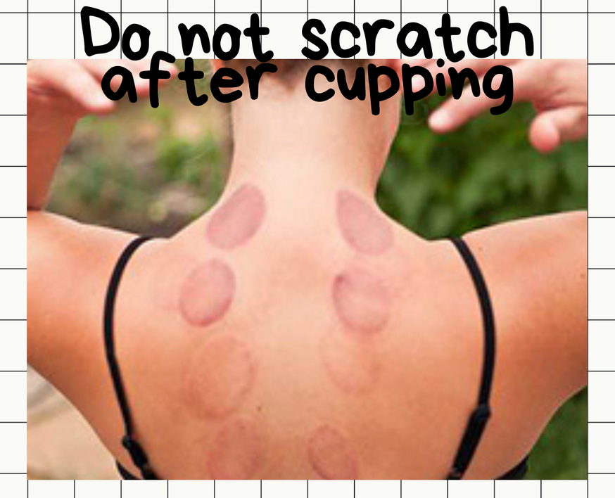 Avoid Scratching After Cupping