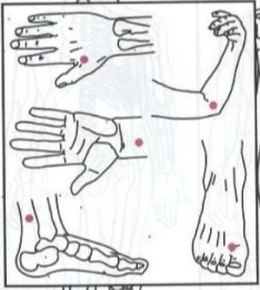 Hijama Points For Anxiety, Depression And Several Skin Problems