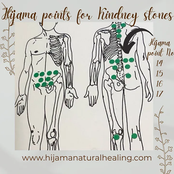 Hijama Points for Kidney Stones