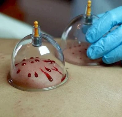 Hijama/wet cupping therapy