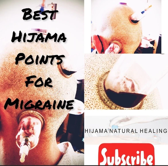 Head Cupping, Best Hijama Points For Migraine