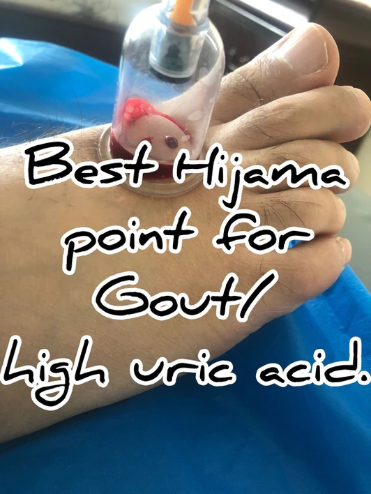 Best Hijama Point For Gout