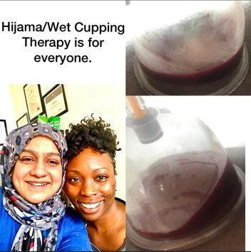 Hijama / wet cupping therapy is for all of us.