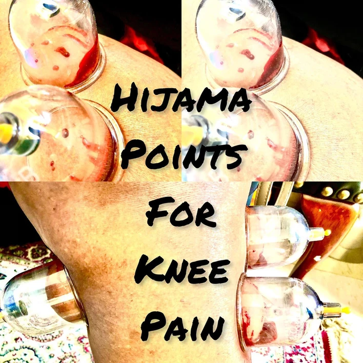 Hijama points for knee pain