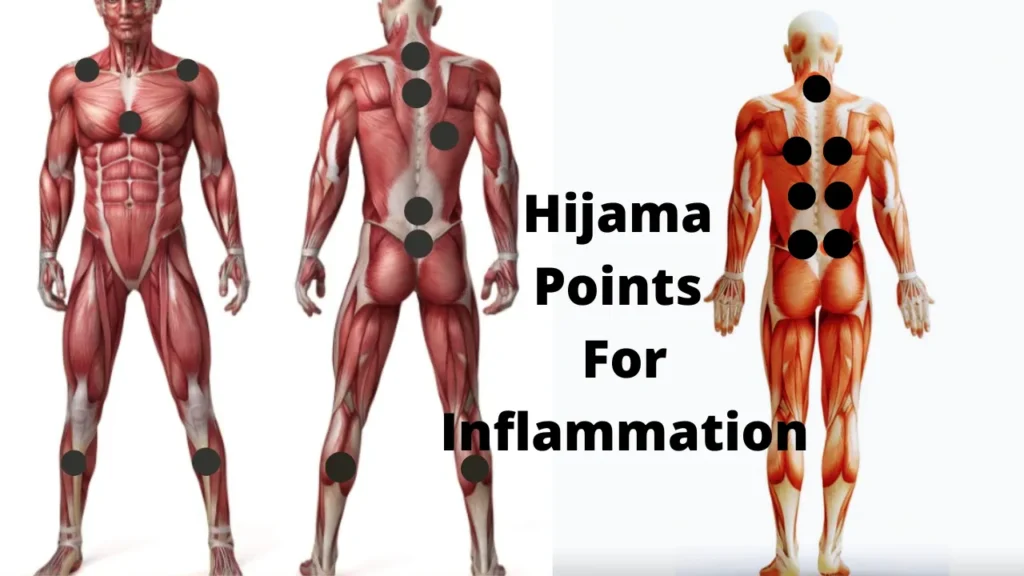 Hijama points for inflammation