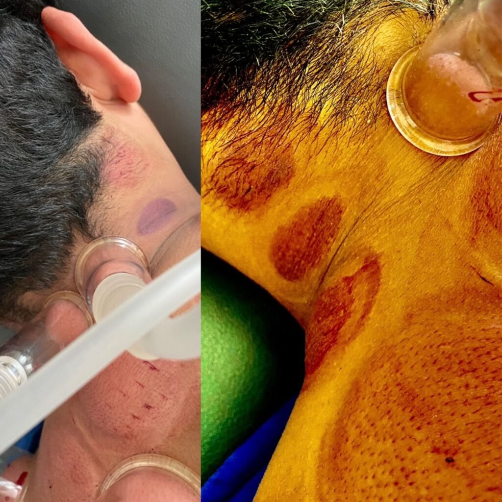 Neck Hijama points