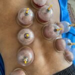 hijama on the back