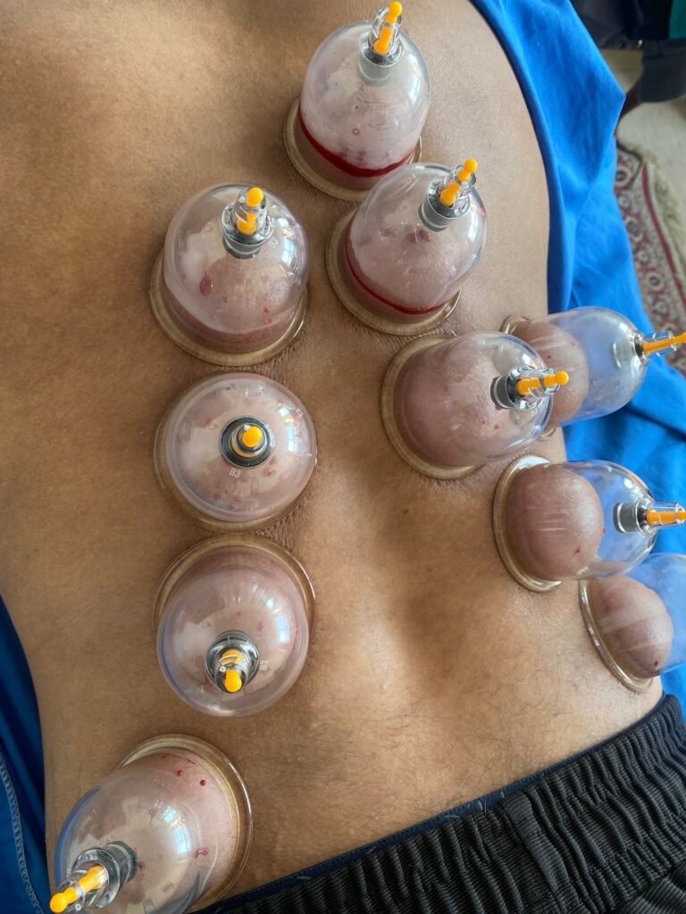 hijama on the back