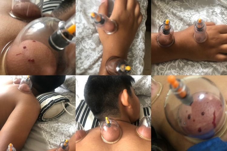 Hijama points on hands and feet