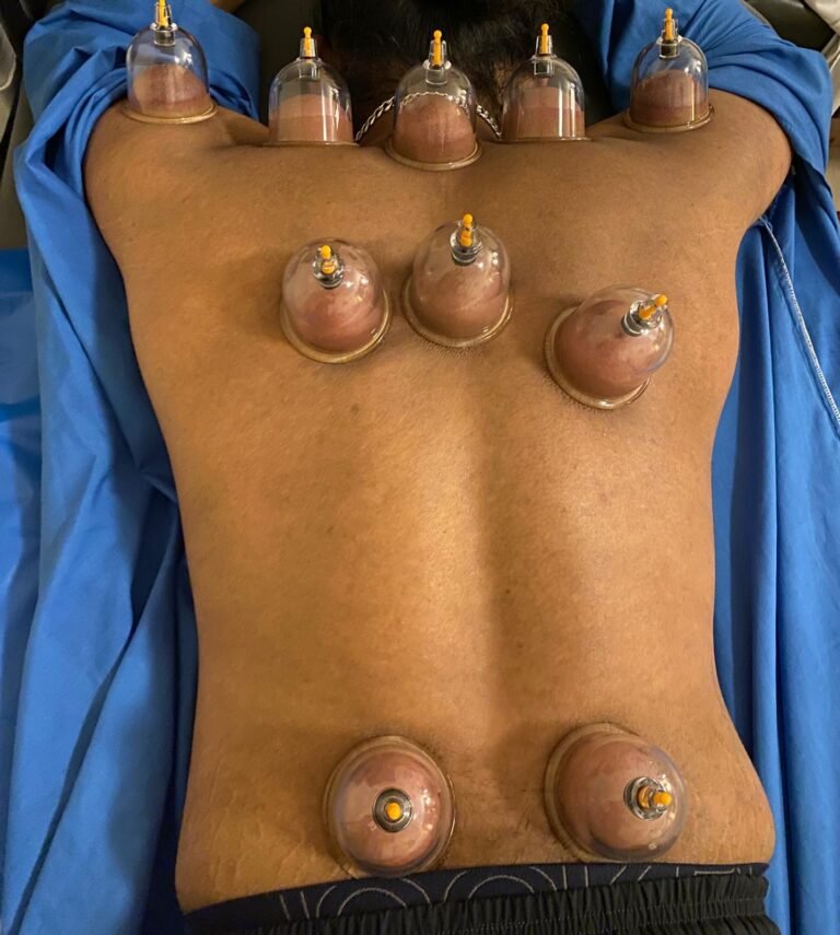 Fixed cupping therapy