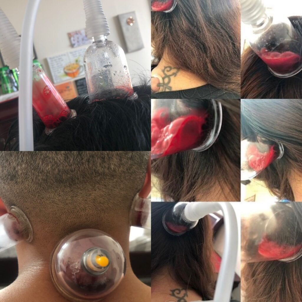 Hijama on the head