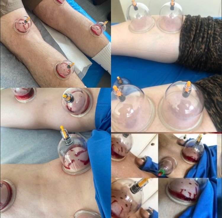 Hijama points on Legs