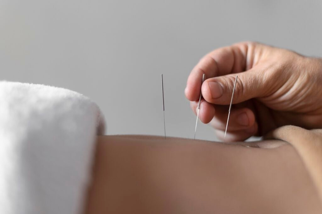 accupuncture needles