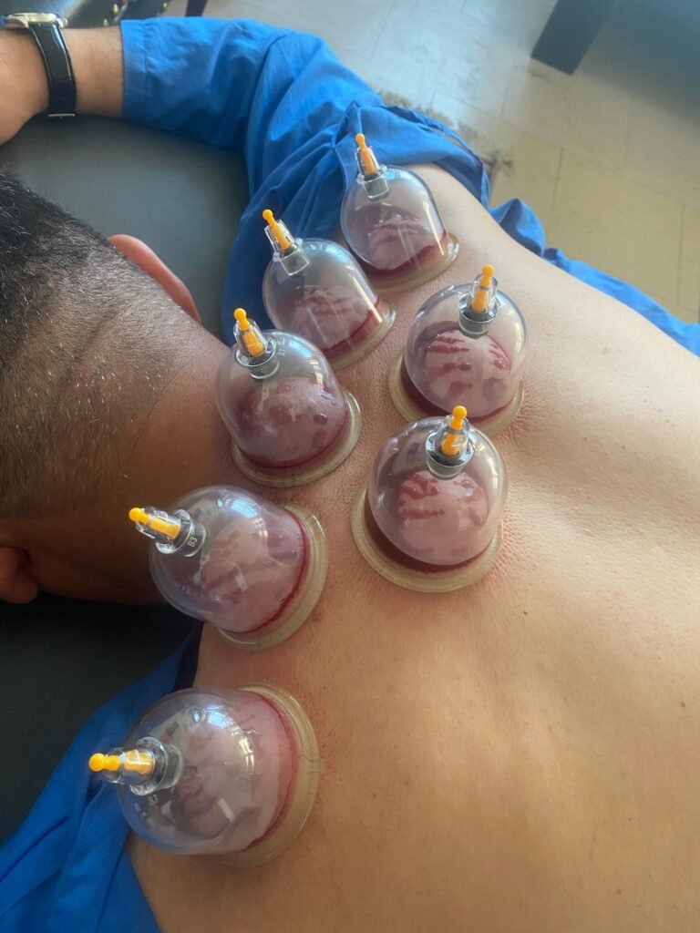 shoulder blade Hijama sunnah points