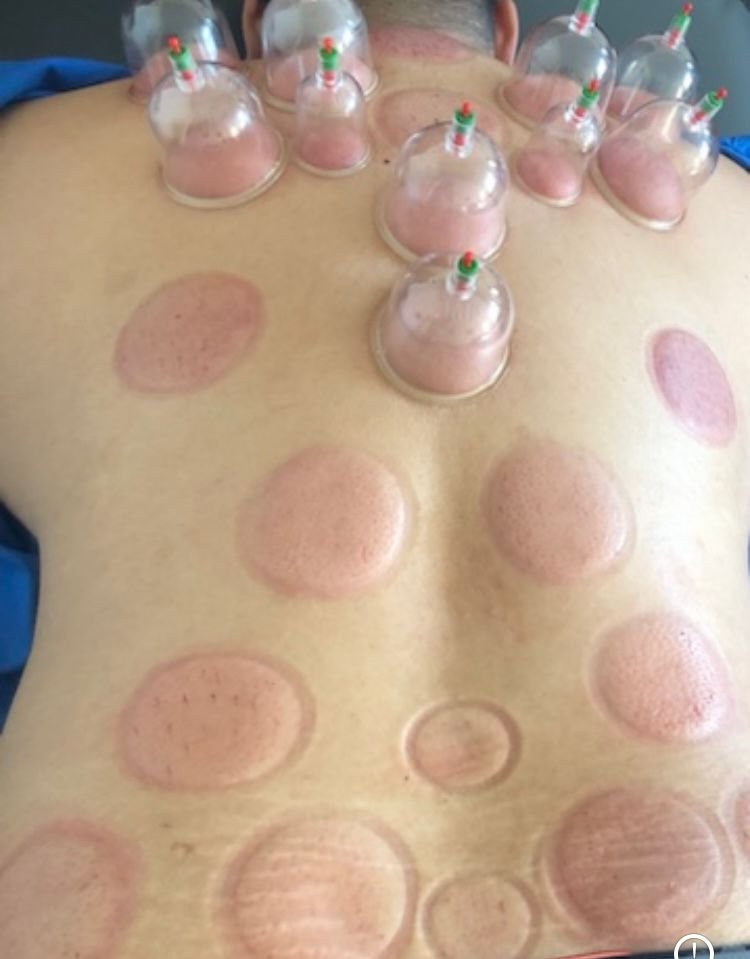 Dry and moving cupping on the whole back