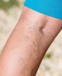 veins