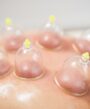 hijama therapy