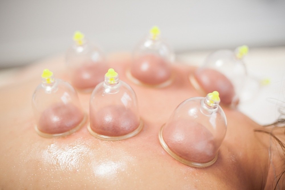 hijama therapy