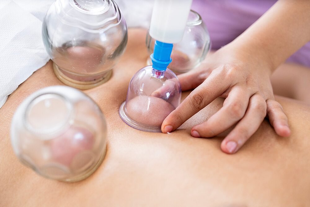 Dry Cupping Therapy An Ancient Practice for Modern Ailments (1)