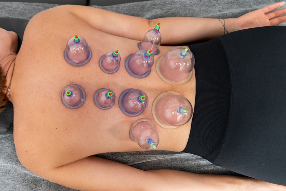 Hijama for Athletes