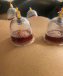 Hijama points