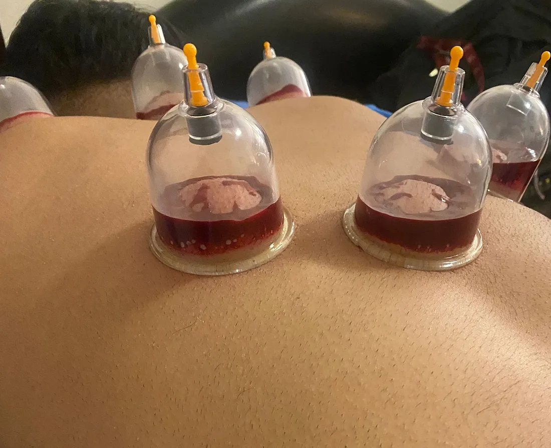 Hijama points
