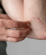 itching on the elbow