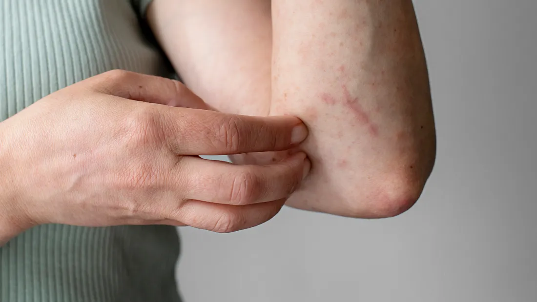 itching on the elbow